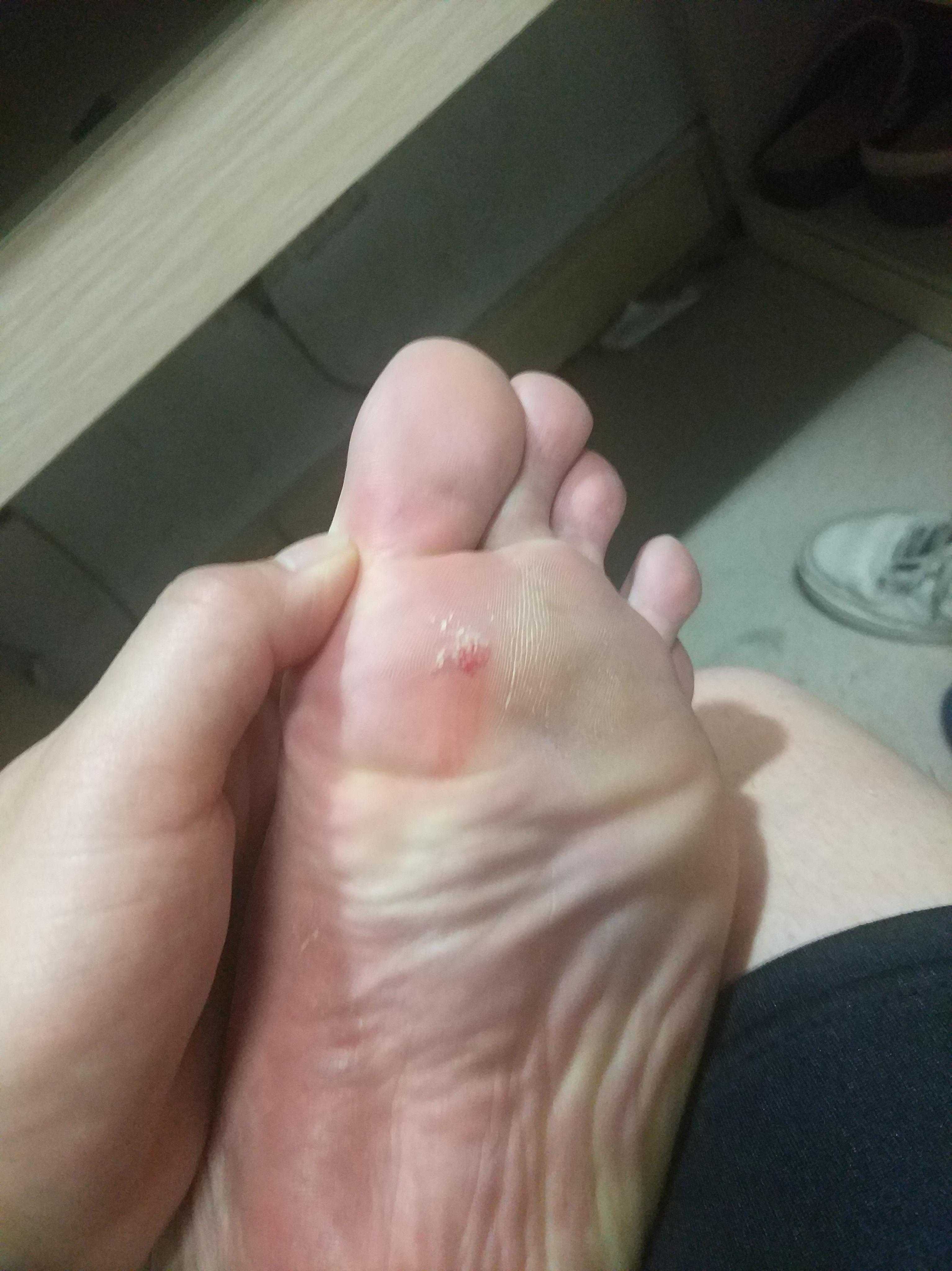 酒精烧脚心虐脚吧_烧脚心吧_用打火机烧美女脚心