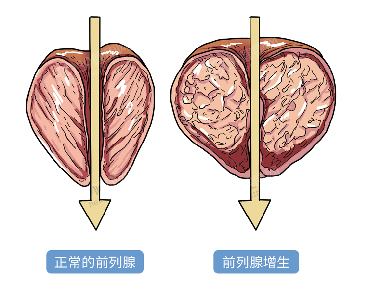 前列腺刹车_什么叫前列腺刹车_前内腺刹车